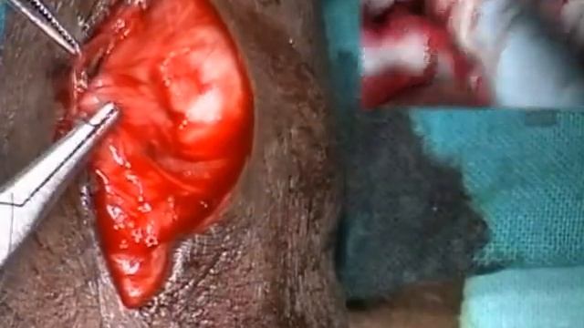 DAY TWO - Case 11 Skin Reorientation and P S Fistula Closure смотреть онлайн