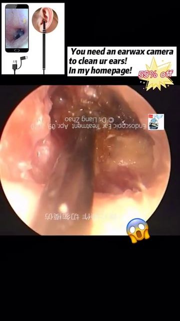 Best Ear Wax Removal & Extraction with Vacuum Remover 真空リムーバーによるにきびの除去と抽出 123 смотреть онлайн