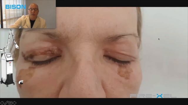 Fire-Xel ( fractional CO2 laser + CO2 laser + analyzer ) Tightening and Rejuvenating BISON смотреть онлайн