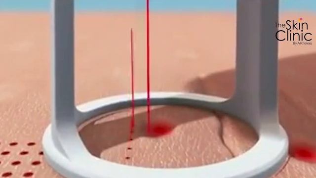 CO2 LASER FOR ACNE SCARS | THE SKIN CLINIC смотреть онлайн