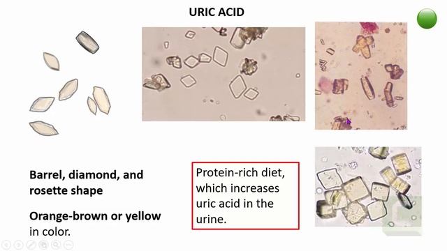 Practical Pathology: Examination of urine sediment- URINARY CRYSTALS смотреть онлайн