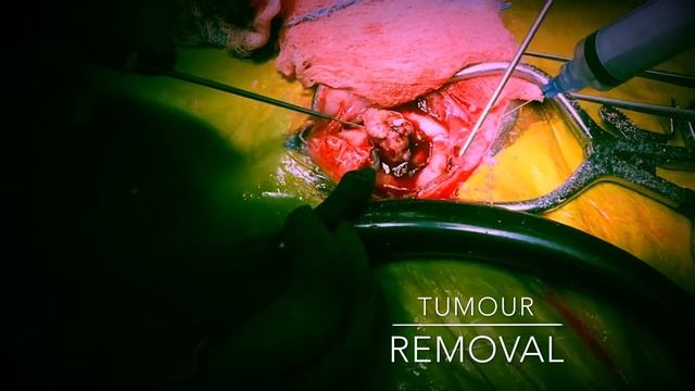 Brain tumor removal in a cat: meningioma resection with titanium plate reconstruction смотреть онлайн