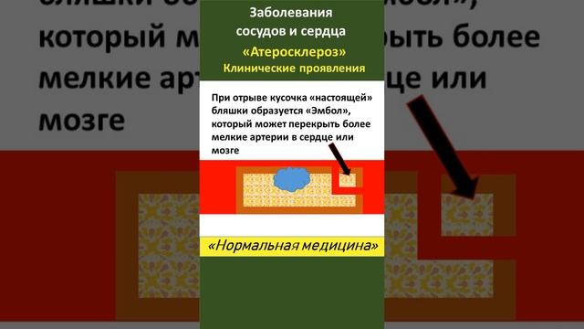 Что в клинических проявлениях Атеросклероза правда, а что нет? смотреть онлайн