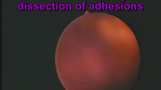 Curettage after delivery - the risk of adhesions. Hysteroscopy 2 years after curettage смотреть онлайн