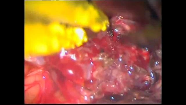 Brain AVM Surgery, Malformación Arteriovenosa Cerebral (Thrace-Greece) смотреть онлайн