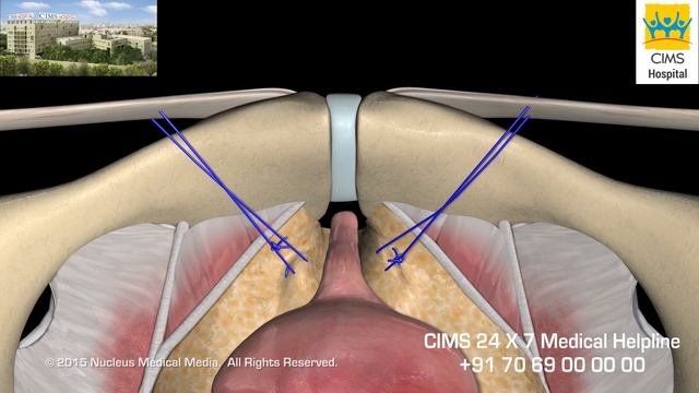 Stress Urinary Incontinence (Hindi) - CIMS Hospital смотреть онлайн