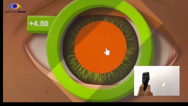 Retinoscopy Part 1 || Static Retinoscopy For Spherical Errors || Myopia || Hypermetropia