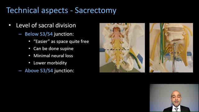 Pelvic exenteration + bone resection (sacrectomy + pubic bone). смотреть онлайн