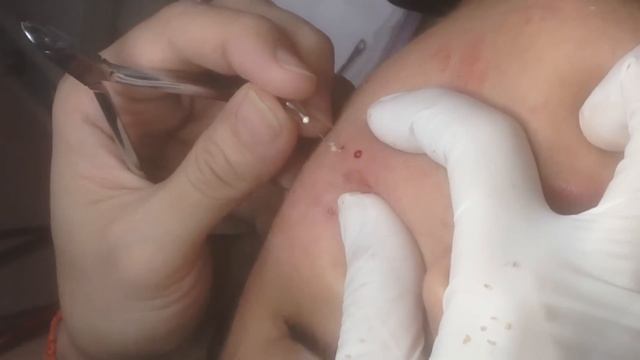 Black Head Removal On Face