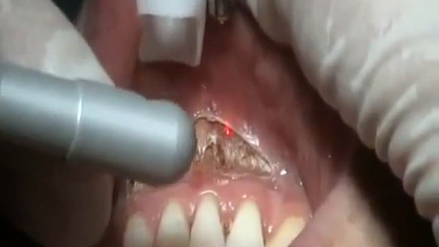Вестибулопластика с помощью лазера DEKA смотреть онлайн