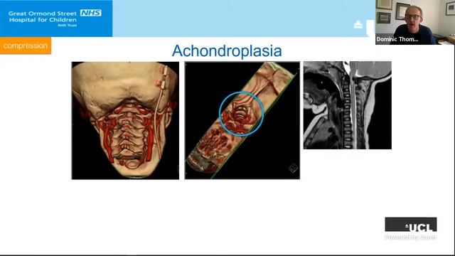 The Craniocervical Junction - Mr Dominic Thompson смотреть онлайн