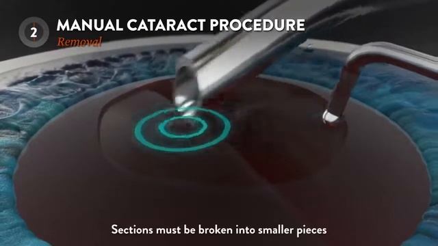 What is FEMTO LASER Assisted Cataract Surgery смотреть онлайн