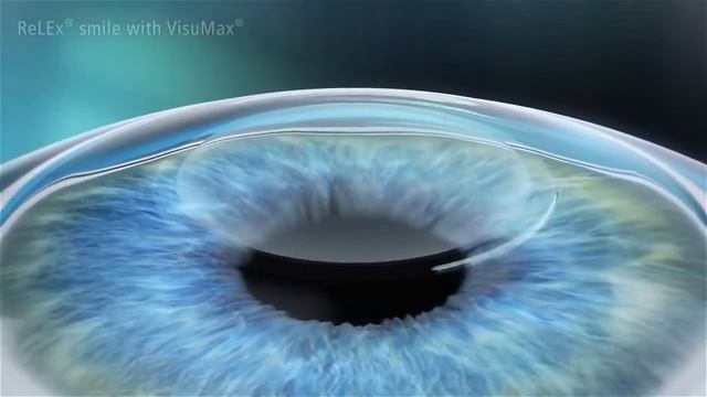How does SMILE surgery work with the ZEISS VisuMax? смотреть онлайн