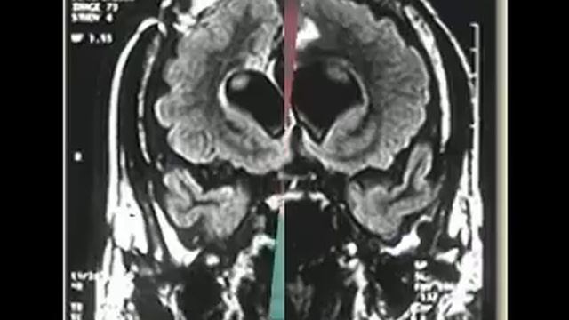 parkinsonsdiseasesurgery смотреть онлайн