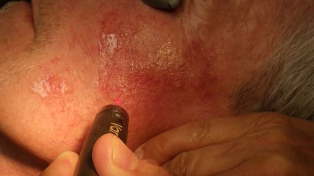 940 and 532 nm Laser Treatment of Facial Telangiectasias by Dr. Joe Niamtu смотреть онлайн