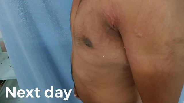 Patient For #gynecomastia