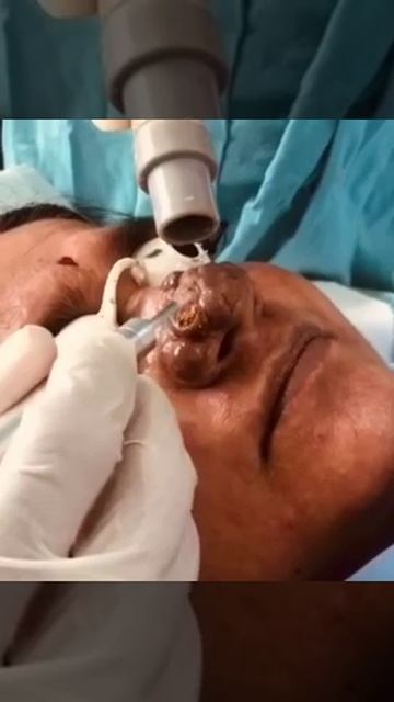 Laser Treatment for RHINOPHYMA (Potato Nose) смотреть онлайн