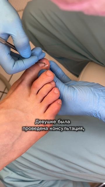 Лечим вросший ноготь на любой стадии ✅ Не забудьте подписаться 📲 смотреть онлайн
