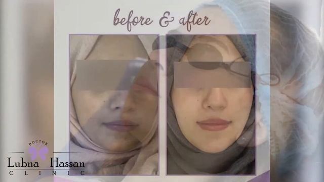 Carbon Laser | Dr. Lubna Hassan Clinic смотреть онлайн