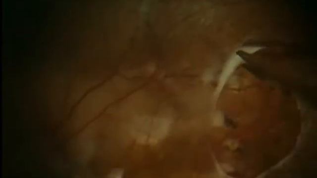 High myopia vitrectomy смотреть онлайн