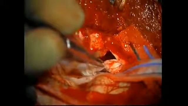 OPERACIYA NA MOZGE UDALENIE KISTY 360 смотреть онлайн