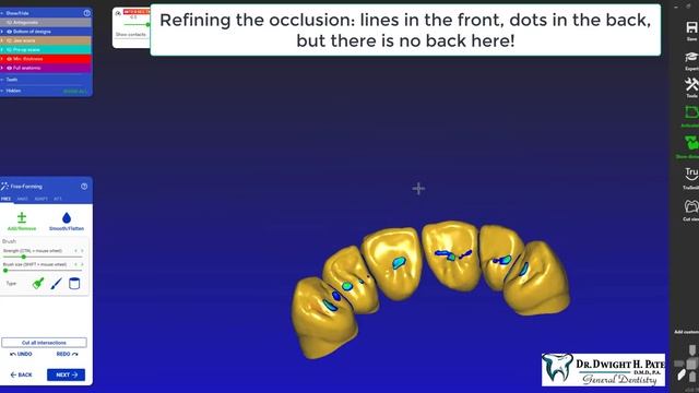 ExoCAD: Diagnostic Wax up of 6 thru 11 for Provisionals for an ERA Partial Denture смотреть онлайн