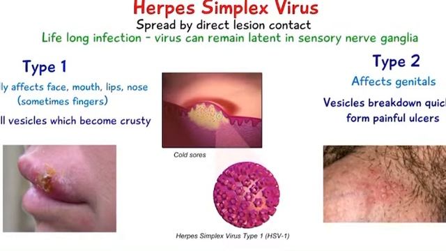 Herpes Simplex Virus Treatment- Dr JOSIAH смотреть онлайн