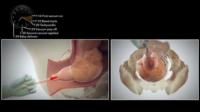 $4M Verdict Animating Vacuum-Assisted Birth Injury смотреть онлайн