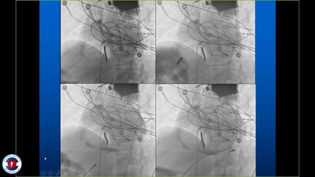 02 - Dr. Claudio Hadid - Ablación De TV En Enfermedad De Chagas