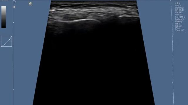 Mediale meniscus gapping varus valgus смотреть онлайн