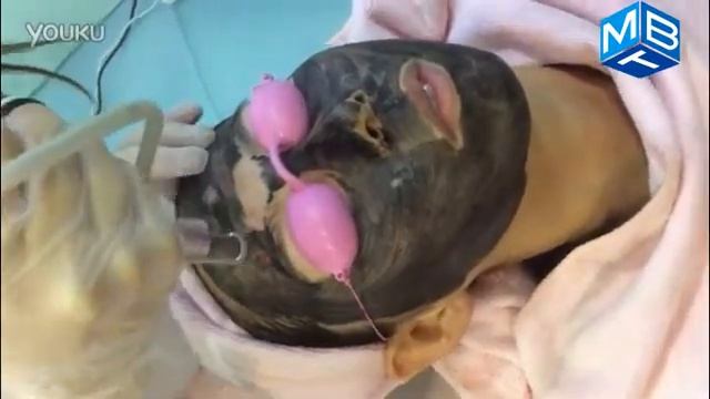 Nd yag laser 1320nm black doll treatment MBT-laser смотреть онлайн