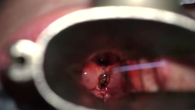 TruBlue 445 nm Laser Assisted Endoscopic Repair of Type IIIa Laryngeal Cleft смотреть онлайн