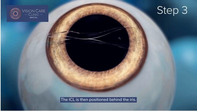 Vision Care Clinic - Implantable Contact Lenses (ICL)