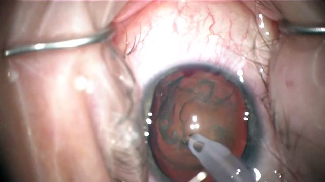 phacotrabectome in advanced pigment dispersion glaucoma; young high myope, iris lens instability смотреть онлайн