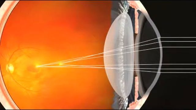 WaveLight® Allegretto Wave® Eye-Q Laser