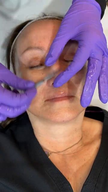 What Is Dermaplaning? | Renewal Med Spa