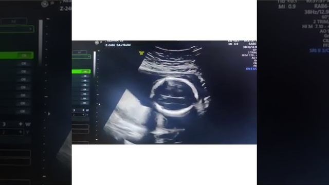 Axial Scan Of Fetus-Dr.Arul's USG Tips- OBG USG Webinar Thro Zoom App -  Whatsapp 8667604376