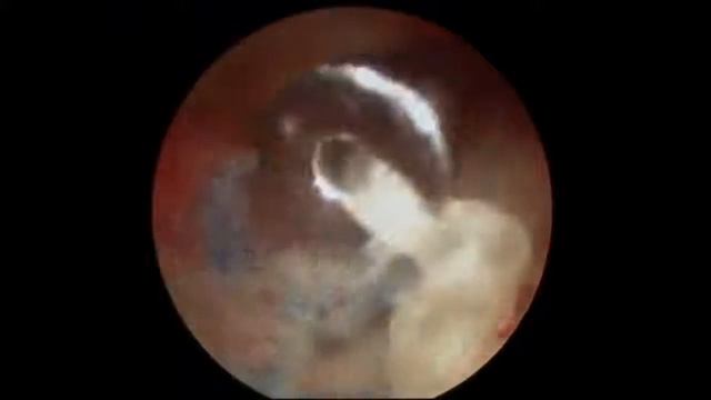 Αρθροσκόπηση (ΔΕ) Ώμου (Συρραφή Rotator Cuff) смотреть онлайн