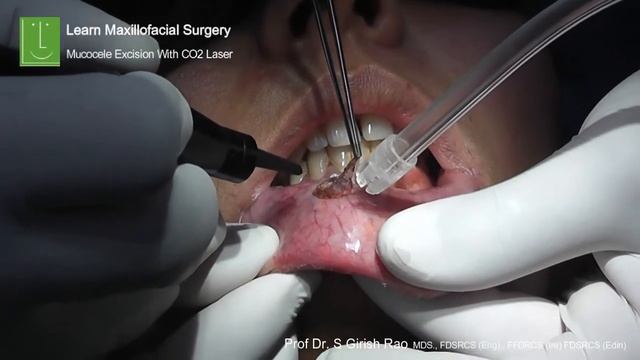 Excision of Fibroma Lip with Co2 Laser смотреть онлайн