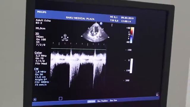 Baku medical plaza Dr. Ulvin Hebibova kardioloq смотреть онлайн