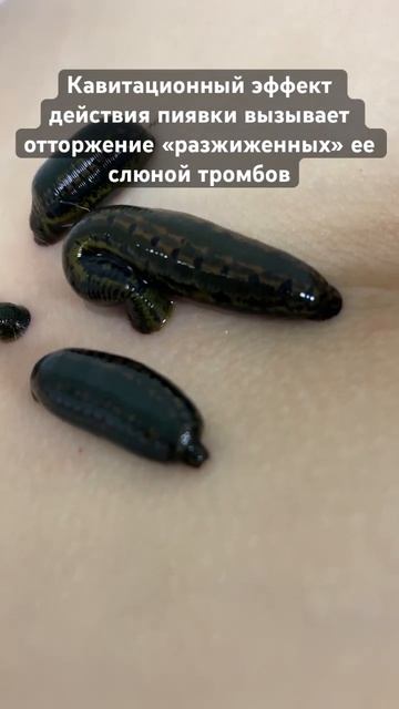 Во время работы Пиявка излучает ультразвуковую волну,что вызывает кавитацию «отработанных»ею тромбо смотреть онлайн