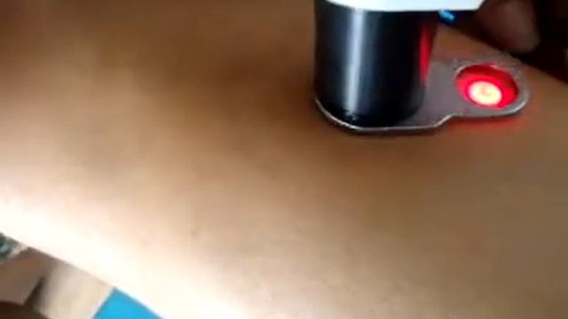 long pulse laser treatment from Winkonlaser смотреть онлайн
