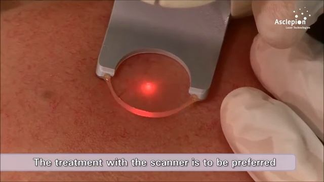 Asclepion QuadroStarPro 577nm 黃激光