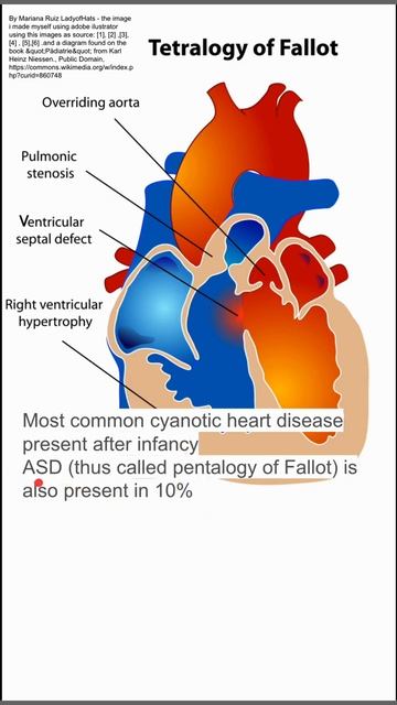 Tetralogy Of Fallot