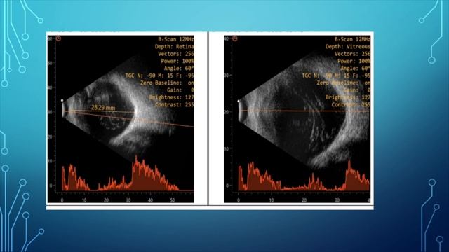 Foveal Sparing ILM Relaxation in Myopic Traction Maculopathy, Dr Owais Ali, 09 Feb, 2023 смотреть онлайн