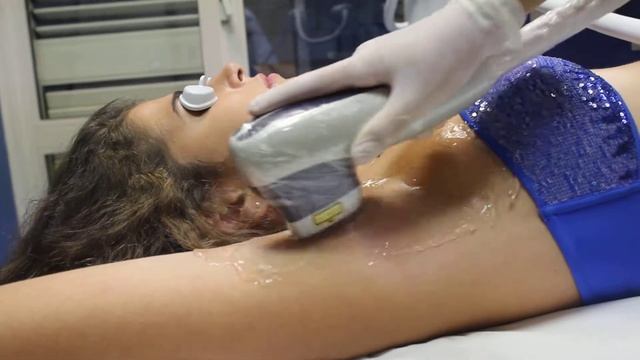 Epilazione Laser "MeDioStar NeXT" смотреть онлайн