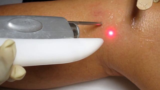 Spider Veins Laser Treatment-Fotona Nd:Yag 1064 nm Laser смотреть онлайн