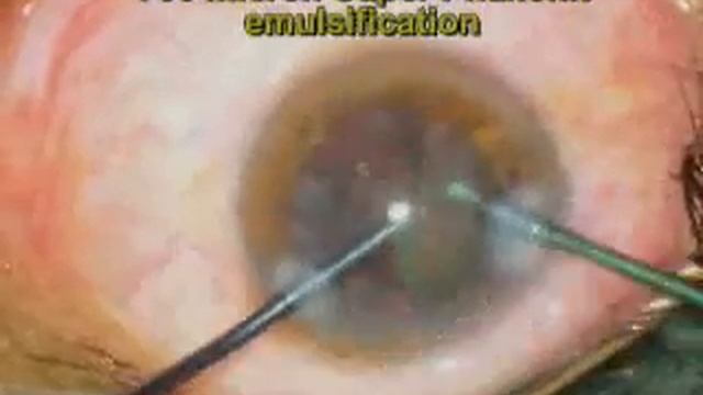 700 micron cataract surgery.wmv смотреть онлайн