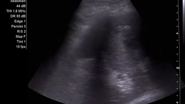 Retroperitoneum Tumor & Hemophthalmus смотреть онлайн