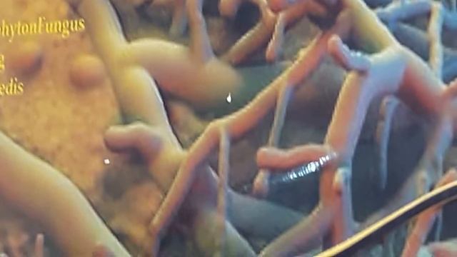 Tinea Pedis. KL смотреть онлайн